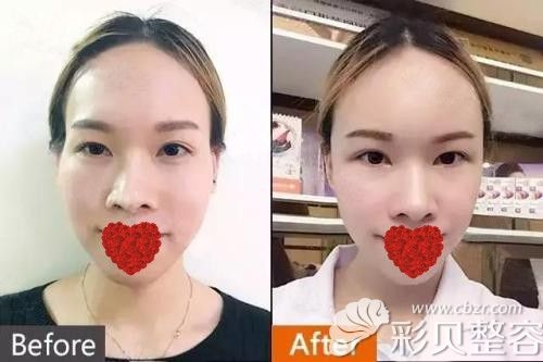 徐海星整容前后照片对比徐海星整容前后对比-第2张图片
