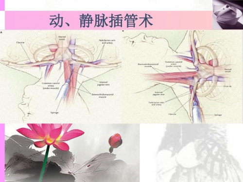 插管第2460期动态图，插管技术的新里程碑